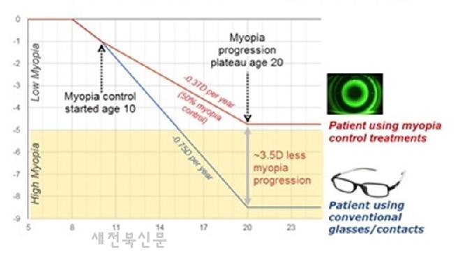 부모 시력이 나빠서 자녀 시력도 걱정된다면, 성장기 고도근시 예방에 드림렌즈 추천